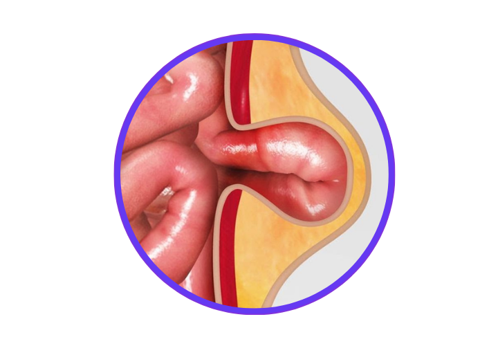 Cirujano de hernia abdominal Queretaro